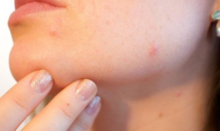 Dreaming about acne: 6 main meanings explained
