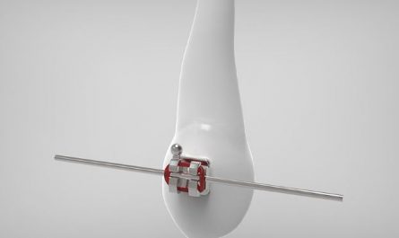 Dreaming of Braces : 8 meanings and symbols