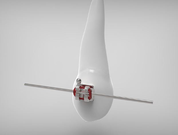 Dreaming of Braces : 8 meanings and symbols