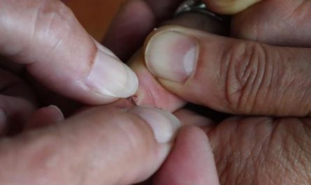 Dreaming of Blisters: 13 Meanings and Symbolisms